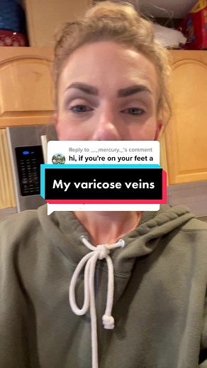 Understanding Varicose Veins: Causes and Treatment Options