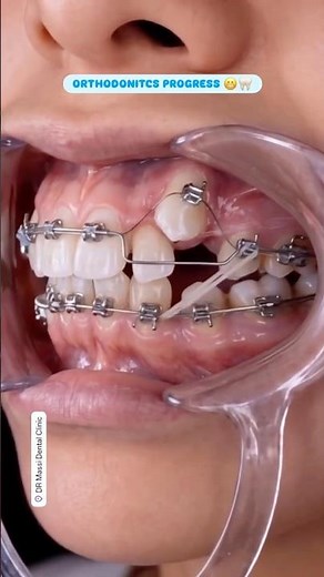 Orthodontics Installation