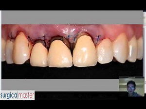 Esthetic crown lengthening mentoring call with SurgicalMaster™