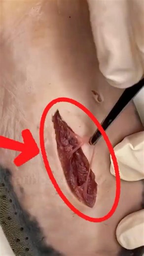 How To Close A Deep Cut🧵