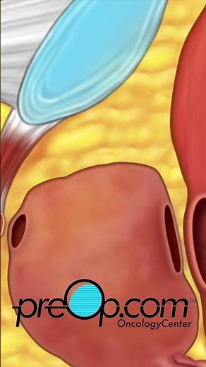 🔍 PreOp® Robotic Assisted Prostatectomy Patient Ed 💡Clinical Skills Made Simple✨ #shorts