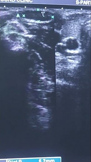 ultrasound neck..reactive lymph nodes