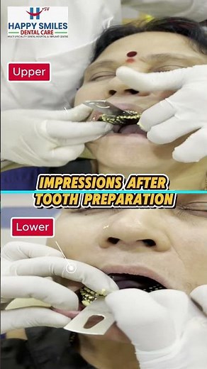 Taking Dental Impressions After Tooth Preparation | Bridge Fixation Step By Step