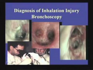 Inhalation Injury - B. Potenza • Video • MEDtube.net