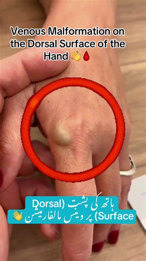 Understanding Venous Malformation on the Hand