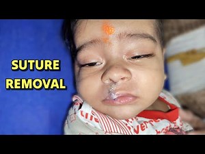 Cleft Lip Repair : Instructions After Suture Removal by Dr Parit Ladani