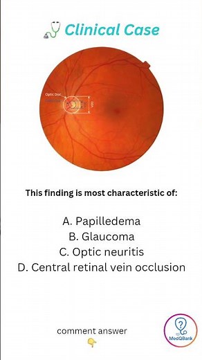Glaucoma Sign 👁️ | Enlarged Cup-to-Disc Ratio | MedQBank