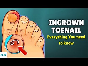 Ingrown Toenail? Causes, Signs and Symptoms & 5 Home Remedies to Fix It Naturally!