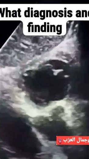 Tricuspid valve short axis view. TTE.Subcostal view.