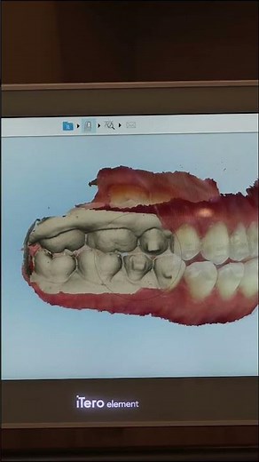 New Retainers Scan | Diamond Braces
