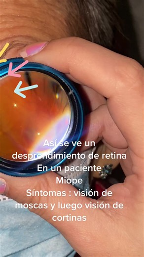 Síntomas del Desprendimiento de Retina: ¿Qué Debes Saber?