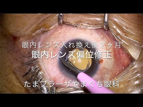 眼内レンズ偏位修正（PanOptix toric）