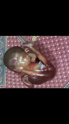 Radiology @all abnormalities 🥏🥏 | Obstetric Ultrasound Report – 2nd Trimester Anomaly Scan Clinical Presentation: Second-trimester anomaly scan. Prior 12-week scan was... | Instagram