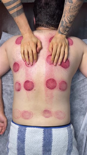 Cupping Therapy ASMR Experience for Relaxation