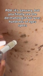 ✨ The journey of a thousand miles begins with a single step. Treating seborrheic keratoses (those “stuck-on” age spots) doesn’t happen overnight—but you’ve gotta start somewhere. ❄️ We use liquid nitrogen to safely freeze them away, step by step. 👉 Follow so you don’t get stuck with a “stuck-on” age spot again. #seborrheickeratosis #agespots #dermatology | Dr. Leela Athalye