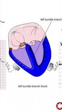 ECG Diagnosis of Left Bundle Branch Block - Some quick tips