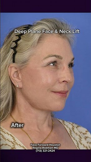 Deep Plane Face and Neck Lift| Before and After| Results