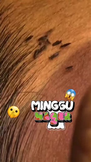 Lice on Scalp: How to Spot and Remove Nits Safely