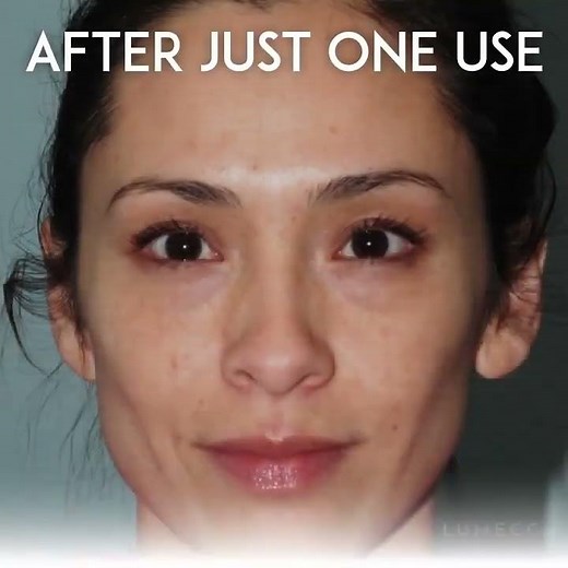 Intense pulsed light (IPL) for skin rejuvenation