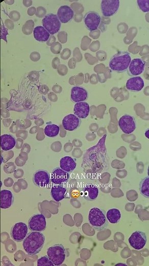 Blood Cancer Under The Microscope 🩸🔬 #healthcare #science #cancer