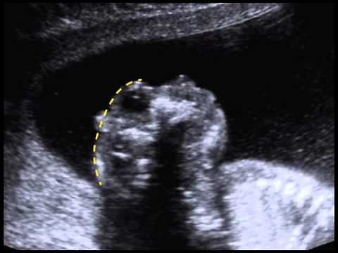 Anencephaly/Acrania (11.11)