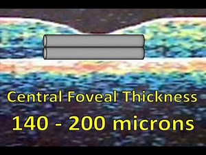 What is Macular Edema? - Aftereffects of a CRVO