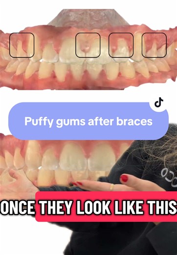 Understanding Puffy Gums After Braces