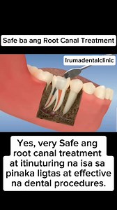 203K views · 343 reactions | RCT or Root canal treatment is a dental procedure used to repair and save a severely damaged or infected tooth, rather than extracting it. #irumadentalclinic #question #tips #rct #rootcanal #endodontics #dental #dentalcare #dentalhealth #oralhealth #oralcare #oralhealthcare #awareness | Iruma Dental Clinic | Facebook