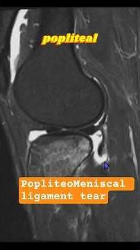Posterolateral corner of Knee !! #MSK #Radiology #MRI #case #teaching #edit#anatomy#foam#frcr