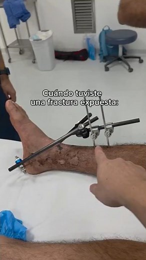 Surgical Treatment of an Open Tibia Fracture: From Emergency to Reconstruction