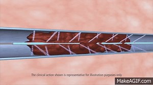 Uni-Fuse Infusion Catheter Animation on Make a GIF
