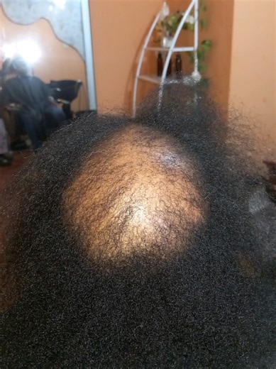 Stage 4 Female Pattern Baldness: Early Intervention Essentials