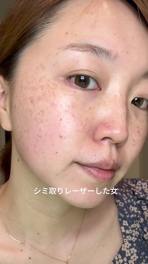 シミ取りレーザー後のダウンタイムメイク方法