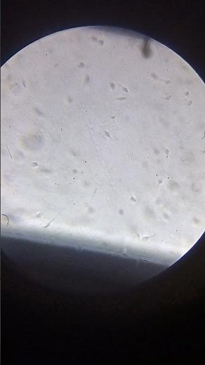 “Microscopic semen analysis – #medical #pathologylab