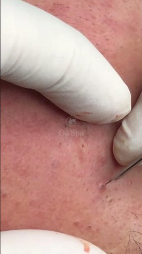 Acne extraction at Ga Spa Clinic #gaspa #acne #phongkhamdalieu #shortsvideo