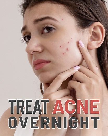 77K views · 73 reactions | Salicylic Acid works wonders to purify your skin. Here's how! | Glamrs | Facebook