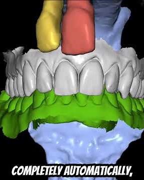 Completely Automatic Aligner Data Setup at $99/Month! #blueskyplan #aligners #orthodontics