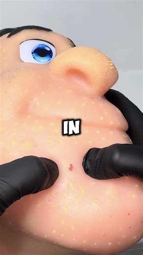 Living with a Shellfish Allergy: Family Misunderstandings