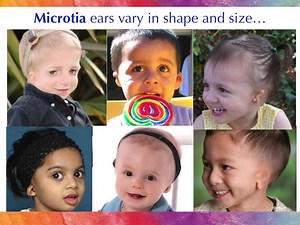 Celebrating Microtia Atresia Awareness! Please help educate others: | Dr. Sheryl Lewin, Microtia Ear Surgery