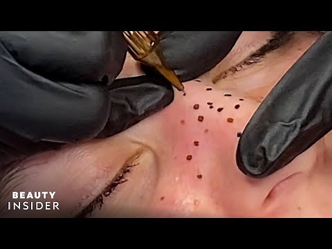 I Got Faux Freckles Tattooed | Beauty Insider