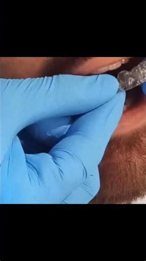 Straighten Your Teeth Without Braces | Clear Aligners #teethaligners #ClearAligners