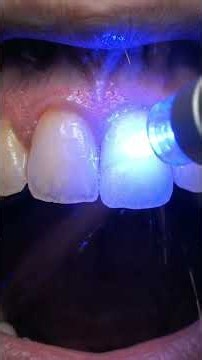 🦷 Watch How a Dentist Restores a Tooth Chipped During a Sports Injury Using Professional Composite