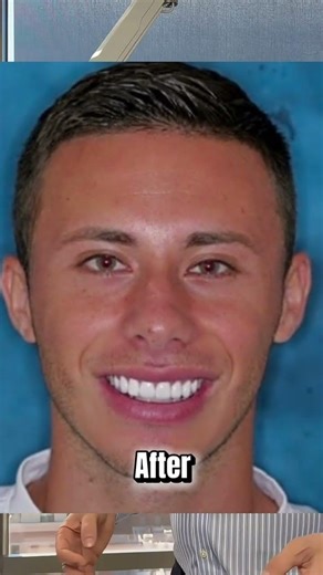Small Teeth? Visible Gaps? Uneven or Spiked Edges? Here’s How Veneers Can Transform Your Smile