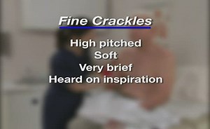 Characteristics of fine crackles