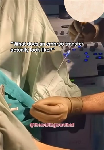 Embryo Transfer Procedure: A Visual Insight