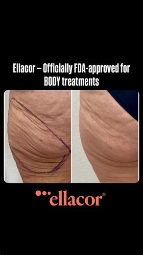 Paul Kim | FL & PR Area Sales Manager on Instagram: "Ellacor — Officially FDA-approved for BODY treatments @drsaluja_drnovo We’re so excited to share that Ellacor is officially FDA approved for body skin tightening and rejuvenation. This innovative micro-coring technology helps improve skin laxity and texture by removing tiny cores of skin-no surgery, no scars, and minimal downtime. Perfect for areas with crepey or loose skin, Ellacor offers real, visible results with precision and safety you ca
