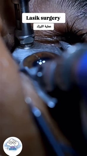 Ophthalmo_Mentor on Instagram: "• @meddmusee What is LASIK surgery? LASIK stands for «laser-assisted in situ keratomileusis.» It is a very common laser surgery procedure used to correct nearsightedness (myopia), farsightedness (hyperopia), and astigmatism. The goal is to reshape the cornea (the clear front layer of the eye) so that light rays are focused directly onto the retina, resulting in clear vision without the need for glasses or contact lenses in most cases. The surgeon uses a very fine 