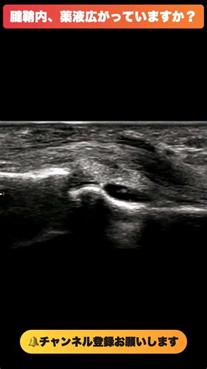 腱鞘内に薬液、広がっていますか？｜ばね指のエコーガイド下注射