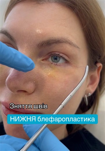 #creatorsearchinsights #блефаропластика #блефаропластикавек #блефаропластикакиї #пластическаяхирургия #пластичнахірургія