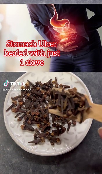 Stomach Ulcer healed with just 1 clove Chewing one clove daily in the morning and drinking water with it is very useful for stomach ulcers. Do it consistently for some time. This video is informational and it is not intended for medical advice. #ulser #stomachulser #selfcare #herbal #herbalife #remedy #desi #fyp #fypシ #fypage #fypシ゚viral #foryou